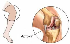 arthrosis of the knee