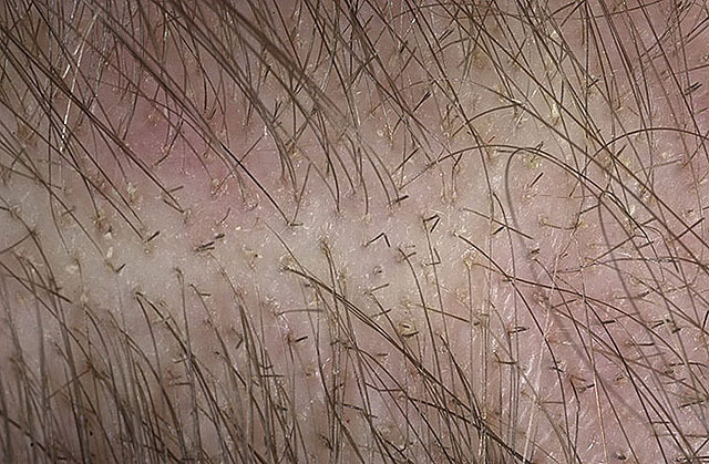 Alopecia anagenică - fotografie