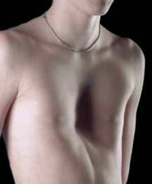 tragtformet bryst
