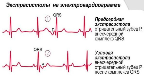 Supraventricular extrasystoles. Rate per day
