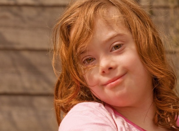 Down Syndrome. Photos of adults, children, karyotype, causes, symptoms, signs, treatment, diagnosis, risk