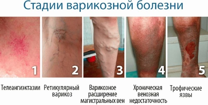 Varicose veins during pregnancy. Symptoms and treatment in women on the legs. Than to smear, exercises, stockings