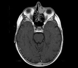 MRI: n paranasal sinusit