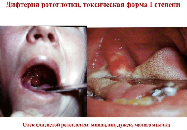 Serum administration according to Frequently: algorithm, scheme, for diphtheria, tetanus, butulism