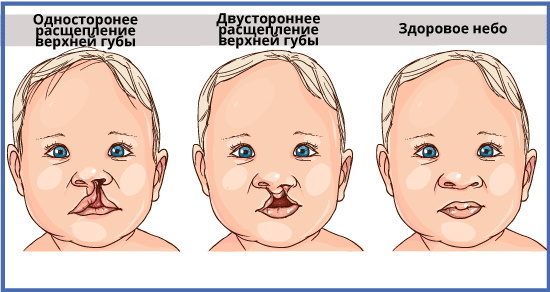 Labbro leporino in un neonato. Foto, motivi, operazione