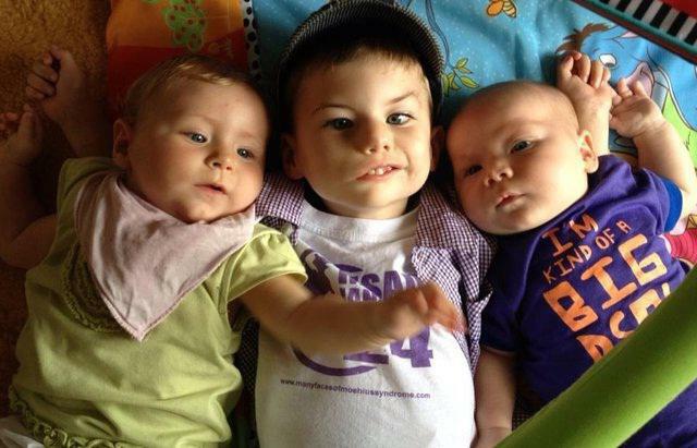Syndrome de Moebius - paralysie congénitale du nerf facial chez les enfants