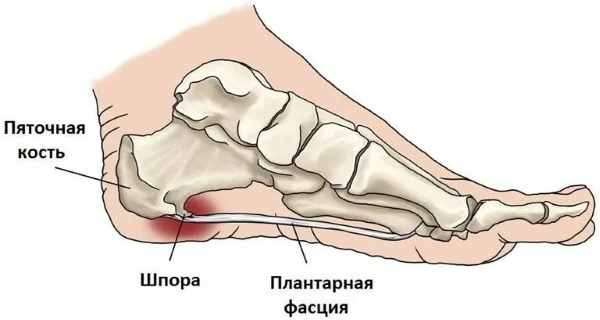 Plantar fasciitis of the foot. Treatment with folk remedies, ointments, gymnastics