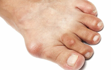 Signs of gout, photos of inflammation