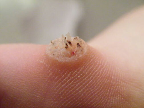 Warts on the fingers and toes