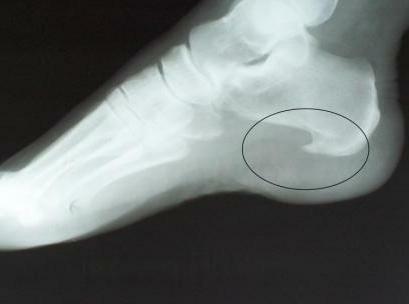 Heel spur in the picture
