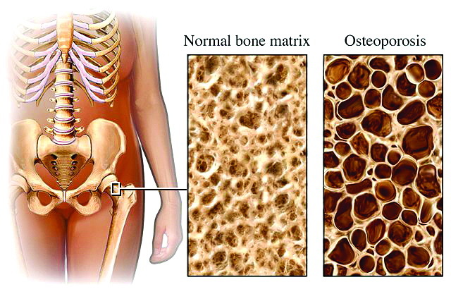 osteoporotic bone