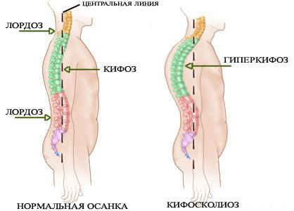 kyphoscoliosis