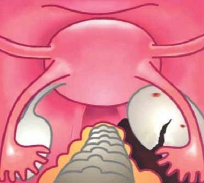 Ovarian cyst rupture