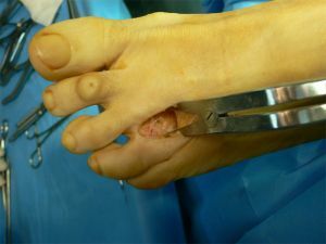 operacja stopy z nerwiakiem