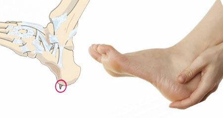 Heel spur - symptoms and treatment at home