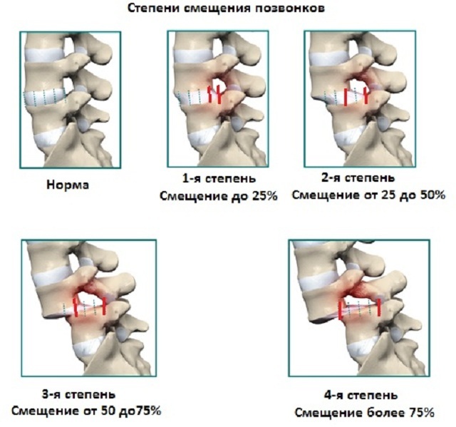 Antelistozis: vertebraların birbirlerine göre tehlikeli yerdeğiştirmesi