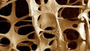 Decreased bone density