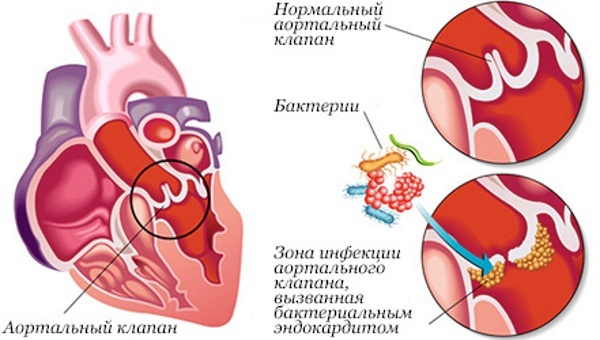 Endocarditis in adults. Symptoms, diagnosis and treatment