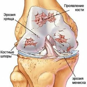What are osteophytes and thorns of the knee joint and how to remove them?
