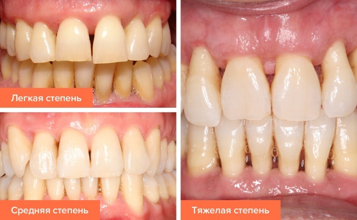 Diseases of the gums and their treatment in infants, adults. List with photo