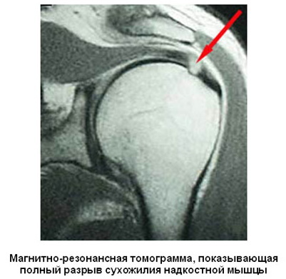 Ruptur av senen i supraspinatus -muskelen i skulderleddet