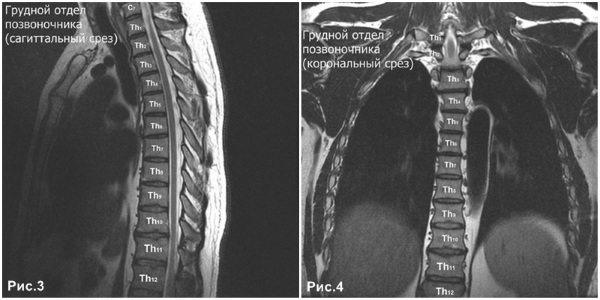 MRI of the spine. How they do it, what shows how the procedure is going, preparation for the examination