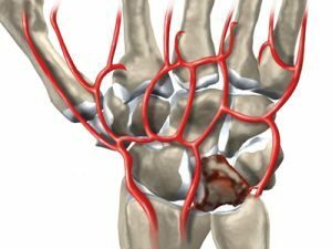 What is osteochondropathy of the half-moon bone of the hand or Kinbeck's disease?