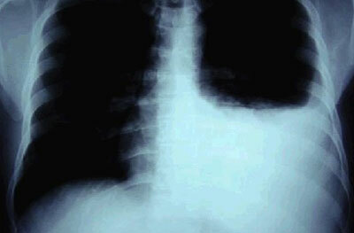Diagnóstico de tuberculose, foto do pulmão de um paciente