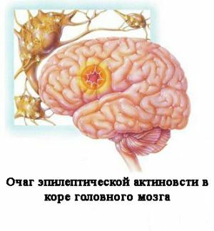 activiteit van epilepsie in de hersenen