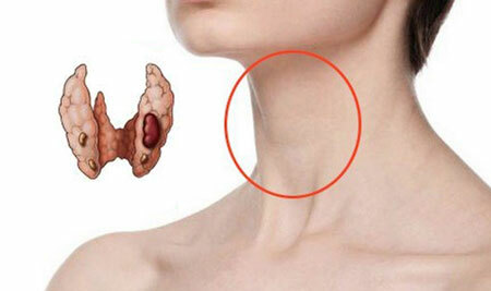 sintomas de cisto da tireoideia