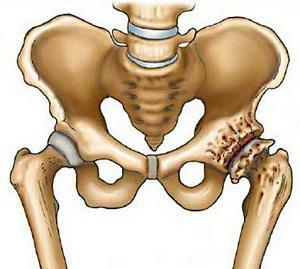osteoarthrosis of the hip joint