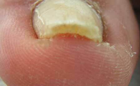 Fotografie a ciupercilor de unghii și picior în stadiul inițial