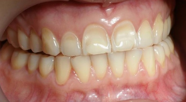 Amazing White whitening. Reviews, what is it, where to buy, before and after photos
