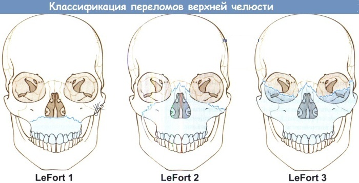 Fracture of the upper jaw. Treatment, first aid, symptoms, classification: open, subbasal, comminuted, closed