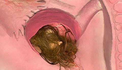 Terratome ovarien
