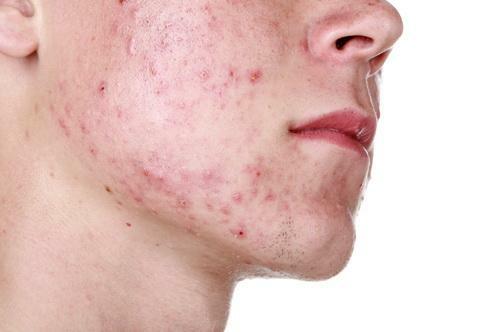 How to treat demodicosis on the face?