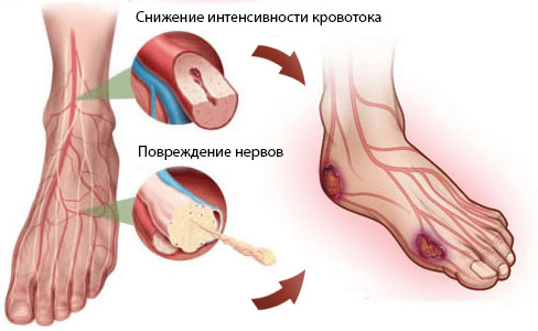 Diabētiska pēda