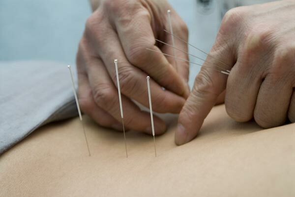 Manoma, kad akupunktūra ar akupunktūra padeda susidoroti su įvairiais negalavimais