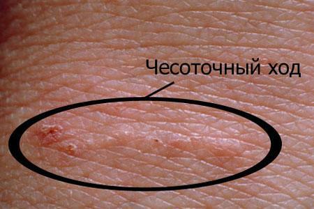 Scalping on human skin