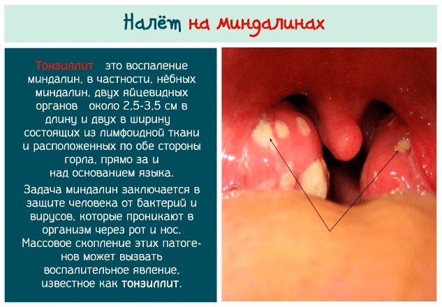 Tubo-otitis. Symptoms and treatment in children, adults, clinical guidelines, causes