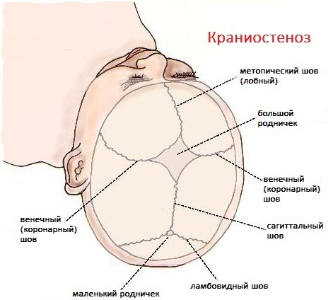 Craniostenosis (craniosynostosis) in children and adults. What is it, symptoms, clinical guidelines