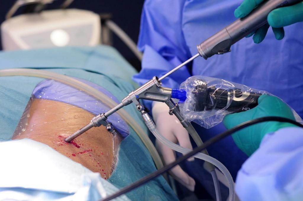Endoskopisk avlägsnande av en hernierad ryggrad
