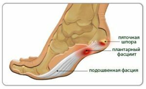 causes of pain in the heel