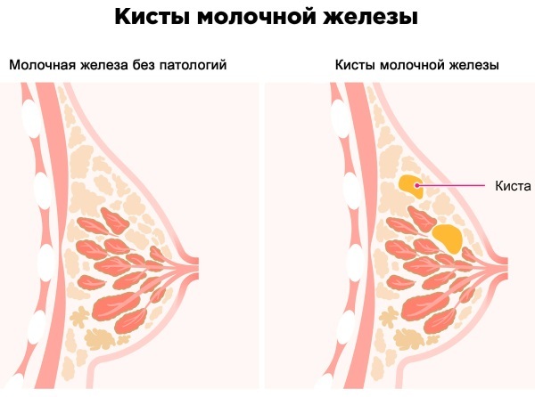 Brystet gør ondt før menstruation, svulmer stærkt. Hvorfor, hvad skal man gøre
