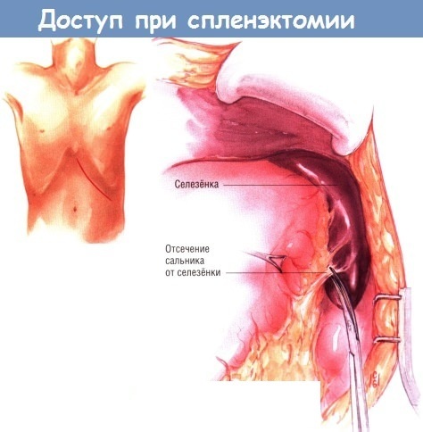 Splenomegaly. What is it, how to treat, causes of moderate, minor, portal, severe, analyzes