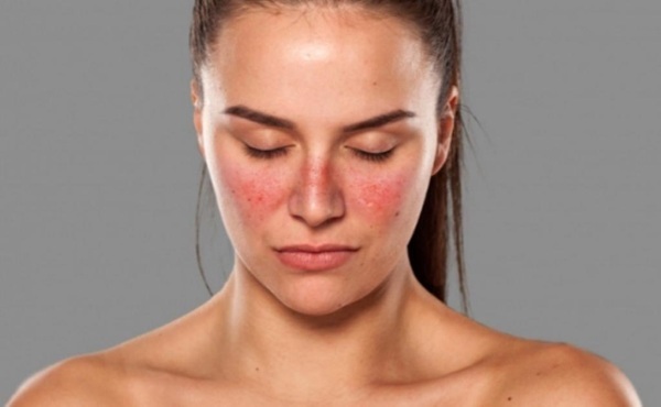 Systemic lupus erythematosus. Diagnostics, analyzes, recommendations, symptoms, treatment