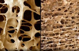 restoration of bones