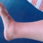 Inflammation du pied