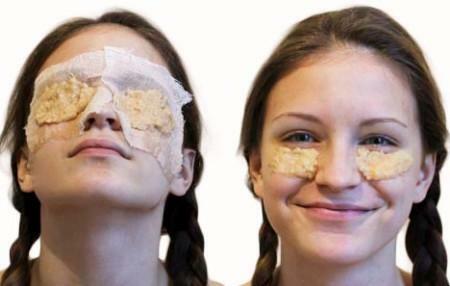 Masks from raw potatoes lighten the skin, make it healthier and shining