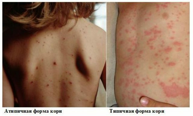 Rash with measles
